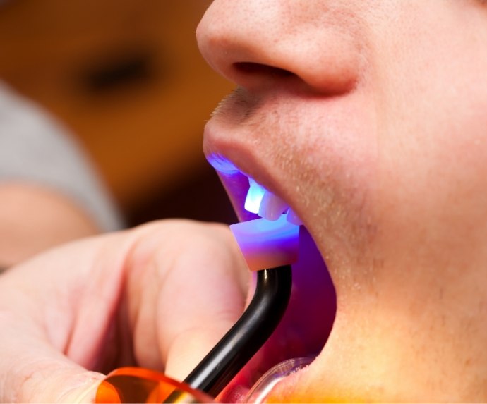 Performing direct bonding on patients upper teeth
