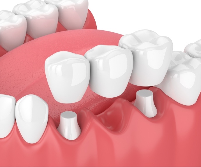 Illustration of dental bridge in Arlington for lower arch