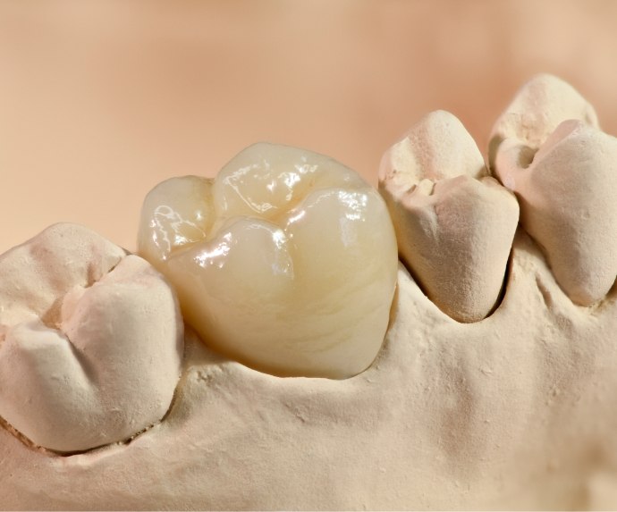 Dental crown in Arlington in mold of teeth