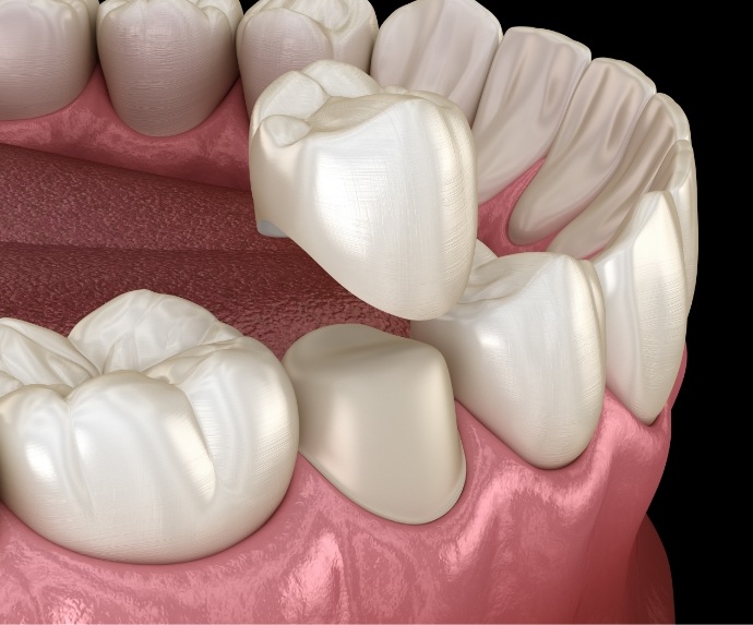 Dental crown being placed on tooth