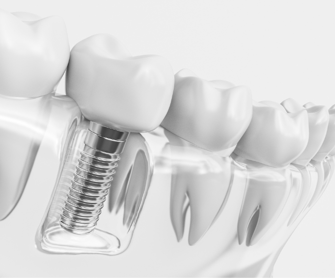 Dental implant in Arlington in a plastic tray