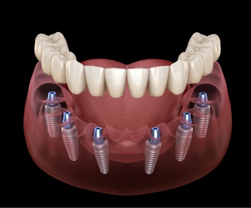 Six dental implants supporting a full denture