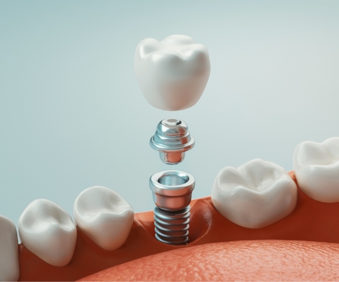 Illustration of dental implant and crown in lower jaw