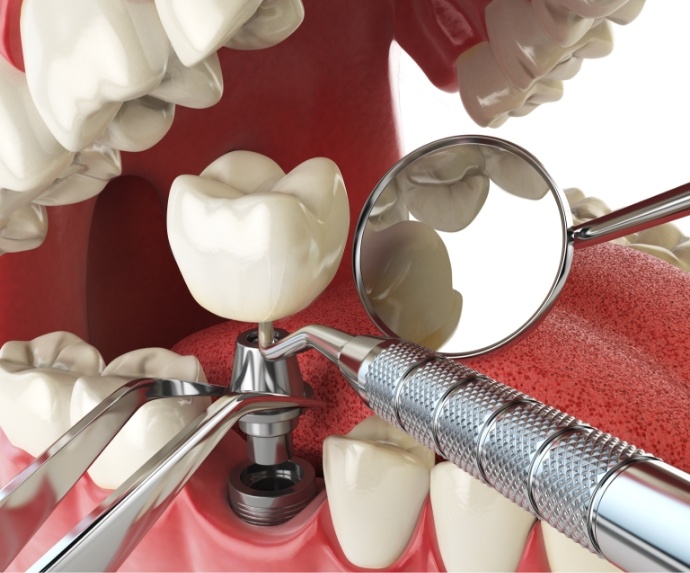 Crown being attached to a dental implant