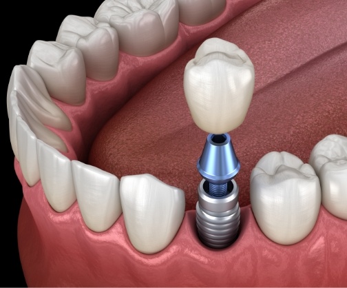 Illustration of single dental implant and crown in lower arch