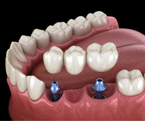 Illustration of dental bridge and two dental implants