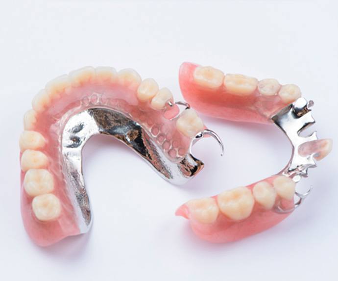 Illustration of single dental implant and crown in lower arch