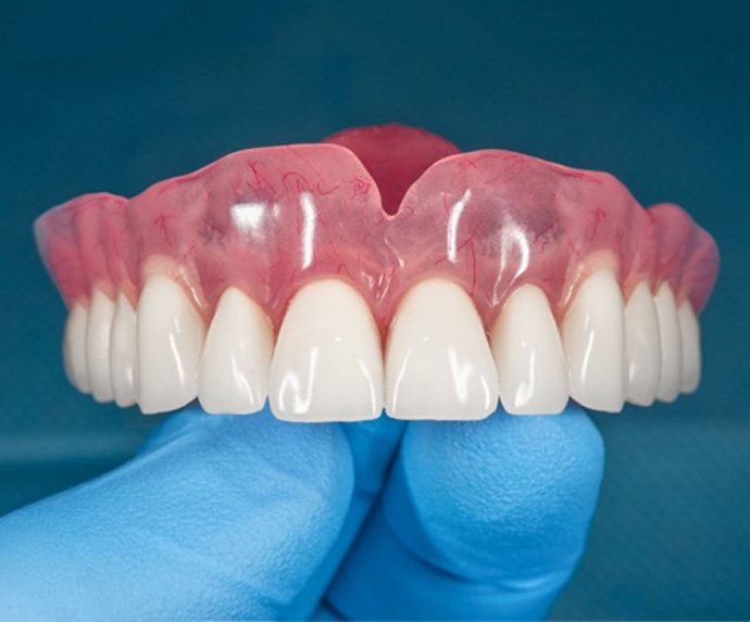 Illustration of single dental implant and crown in lower arch