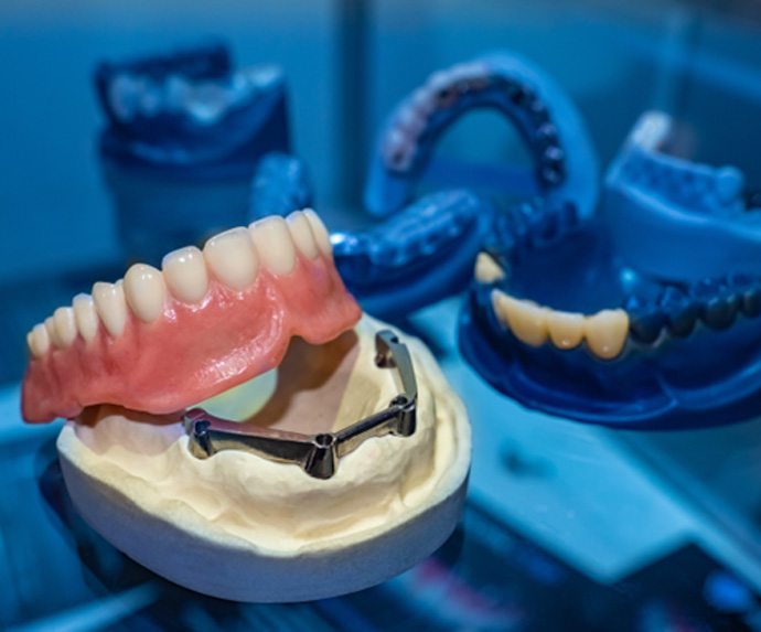 Illustration of single dental implant and crown in lower arch