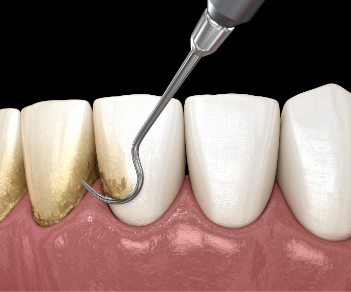 Scaling and root planing performed on lower teeth
