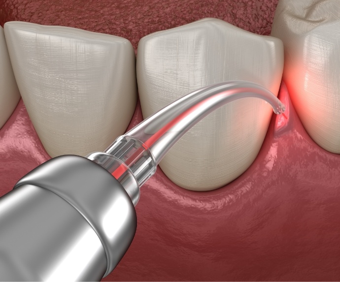 Soft tissue laser for treating gum disease