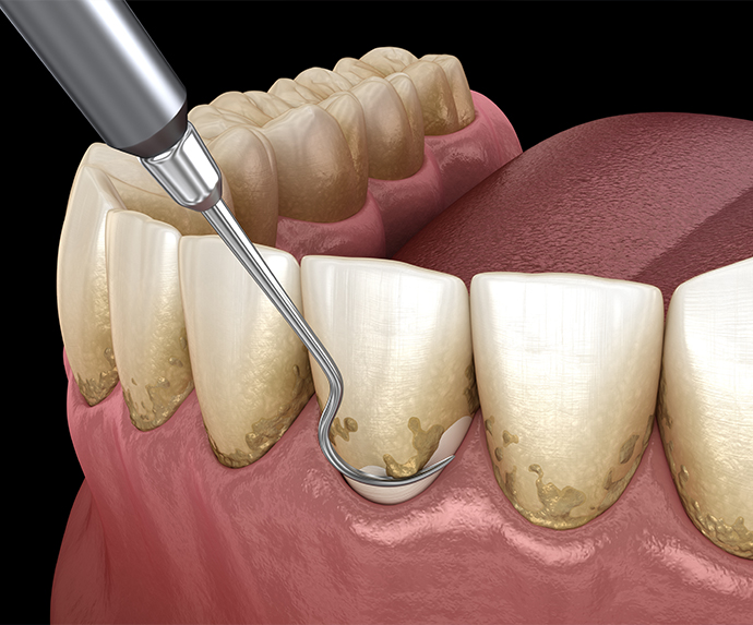 Illustration of periodontal maintenance being performed