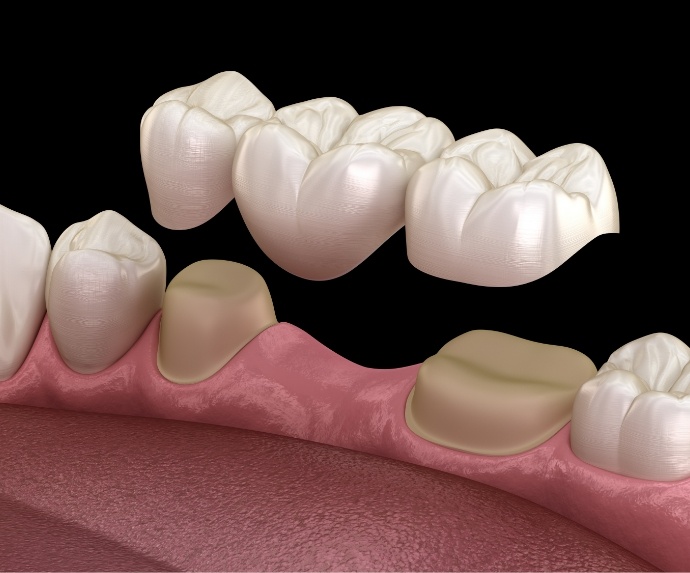 Dental bridge for replacing missing teeth in Arlington