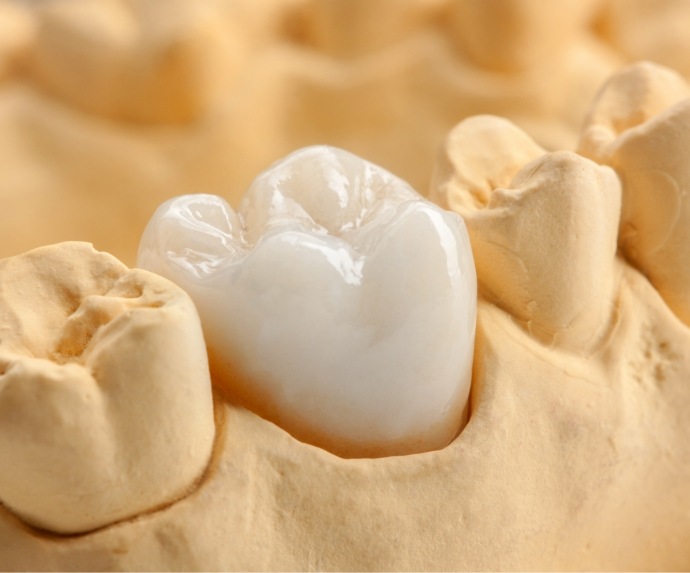 Close up of dental crown in model of teeth