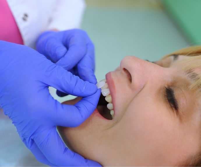 Placing veneers on a female patients teeth